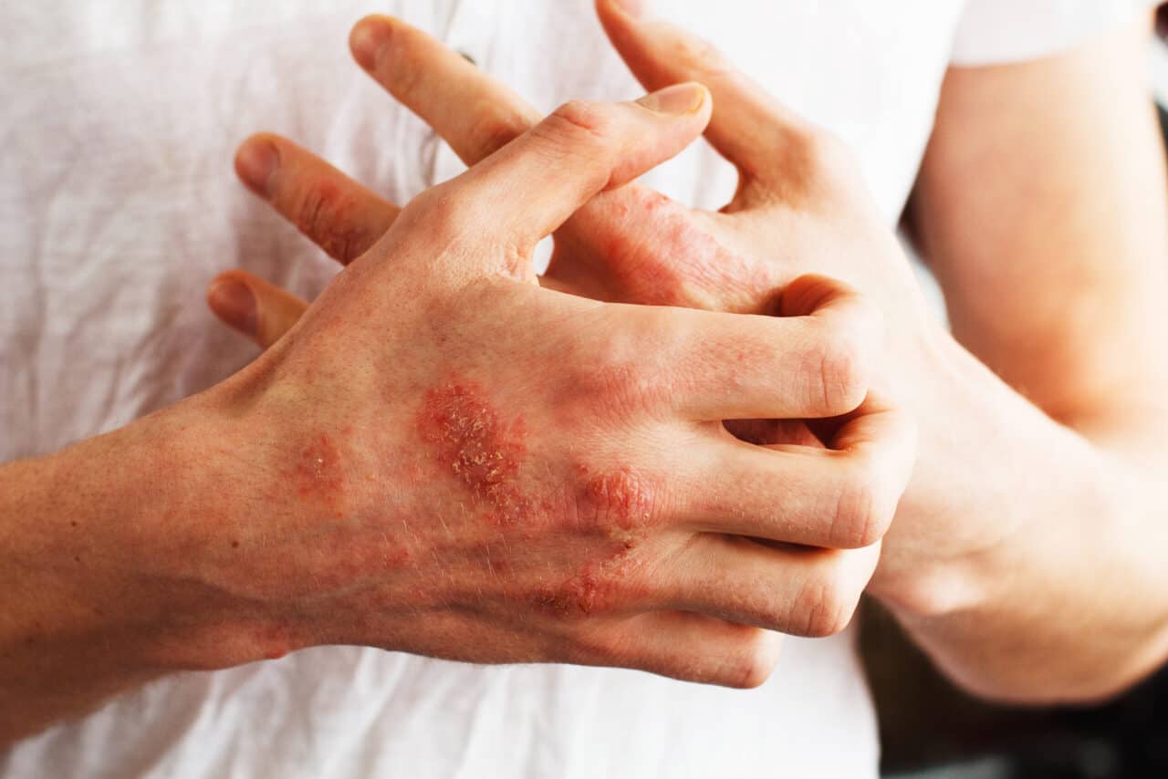 Close-up of hands with visible skin rash