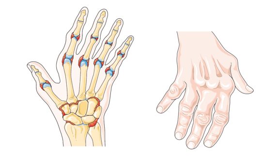 Healthy hand and hand with arthritis