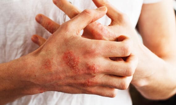 Close-up of hands with visible skin rash