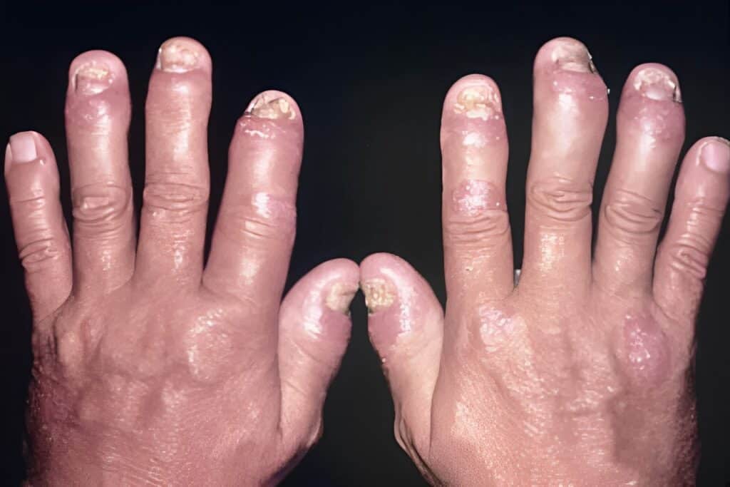 Hands with swollen, inflamed fingers and damaged nails.