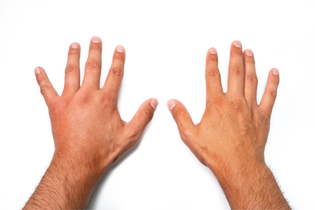 Swollen hands with visible joint inflammation.