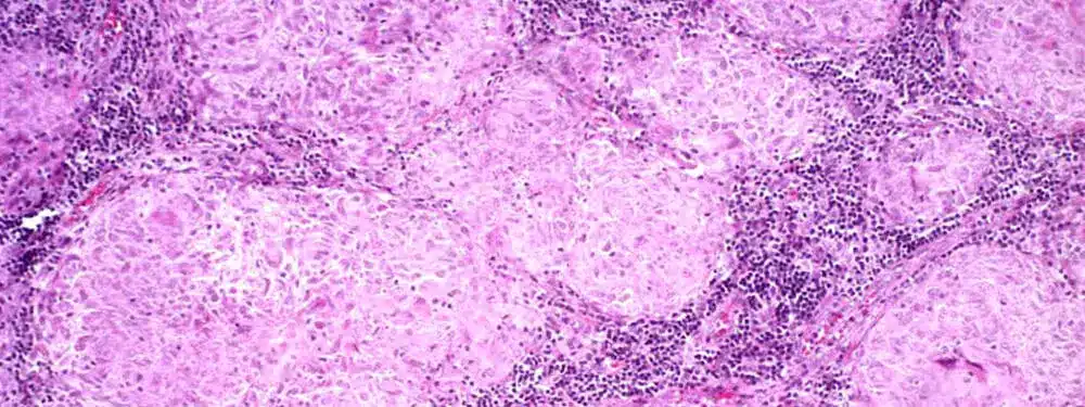 Sarcoidosis